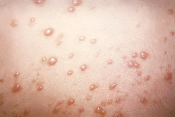 Symptoms of HSV Infection: A Short Illustrated Guide